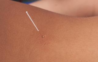 definir acupuntura fisioterapia