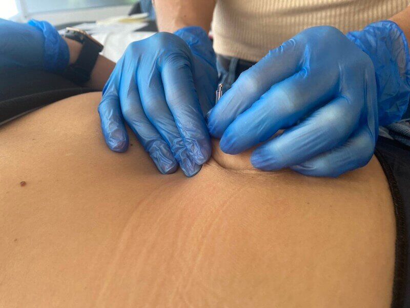 curso punção seca porto